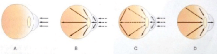 Rosette Cataract