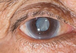 glaucoma surgery eye