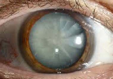 cataract surgery in bangalore