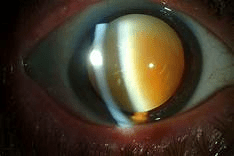 Cataract eye