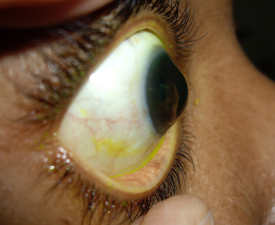 symptoms of Keratoconus