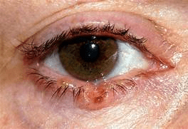 Basal cell carcinoma of eyelid