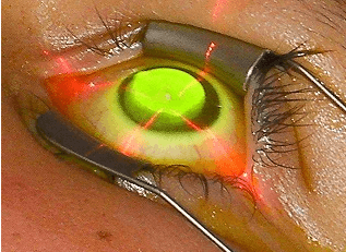 Implantable contact lens