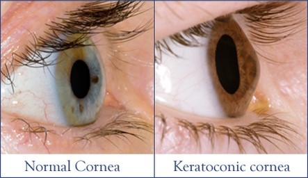 Keratoconic cornea