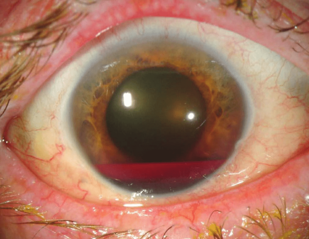 Hyphema with iridodialysis