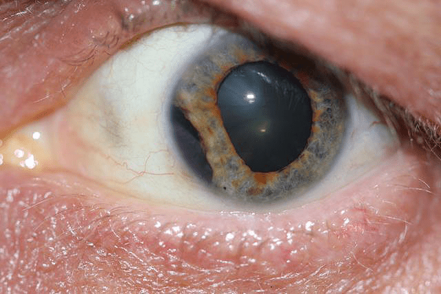 Hyphema with iridodialysis