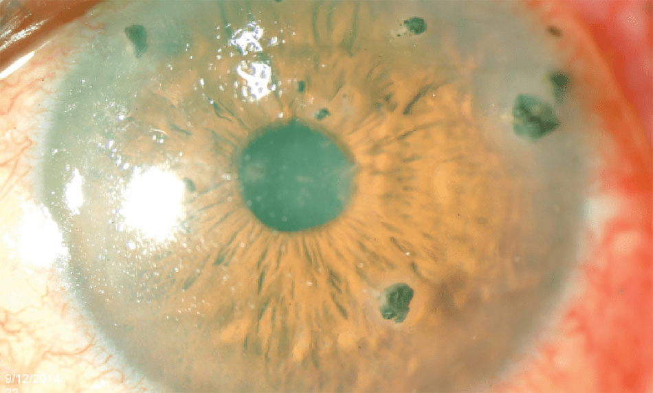 Multiple conjunctival and corneal foreign body