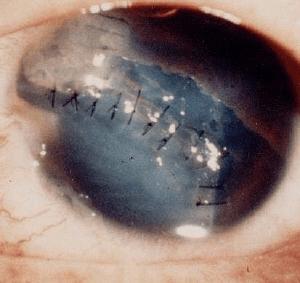 Sutured cornea - scleral tear