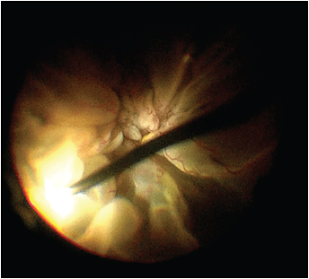 Traumatic retinal detachment