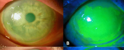 Total corneal epithelial defect with severe inflammation