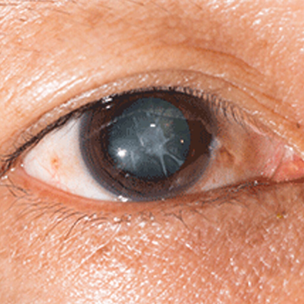 Eye Drops To Prevent Or Cure Cataracts?