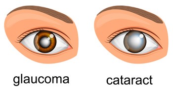 Glaucoma & Cataract