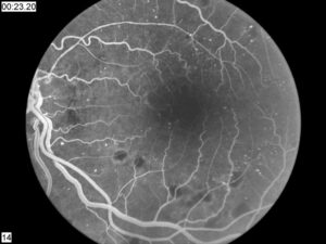Can Diabetic Retinopathy Cause Blindness?