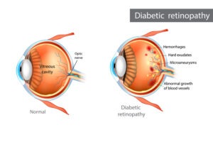 Diabetic Retinopathy