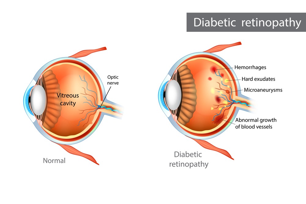 Can Diabetic Retinopathy Cause Blindness Shekar Eye Hospital