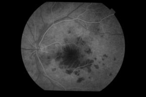 Can Diabetic Retinopathy Cause Blindness?