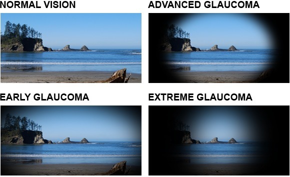 Glaucoma Awareness Week 2025