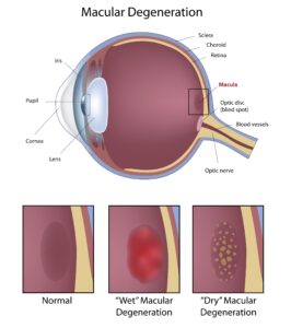 macular degeneration