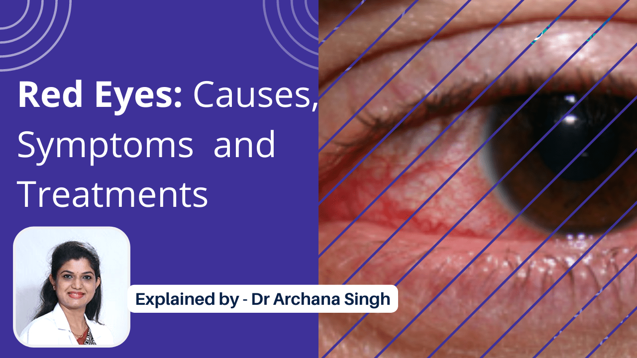 Causes & Treatments of Red Eyes | Shekar Eye Hospital