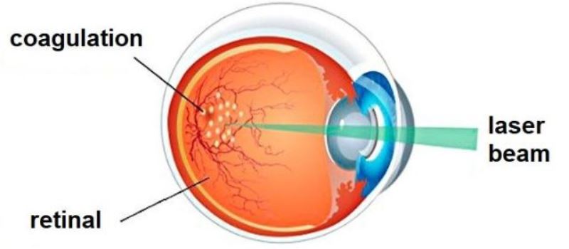best treatment for diabetic retinopathy