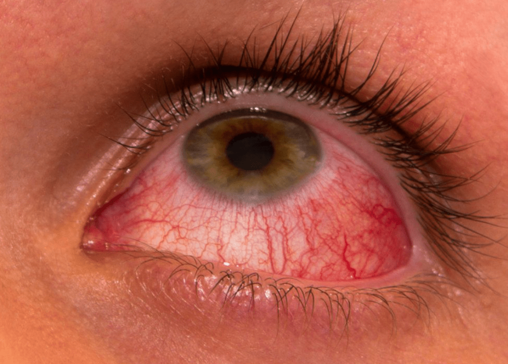 contact lens related problems - infection