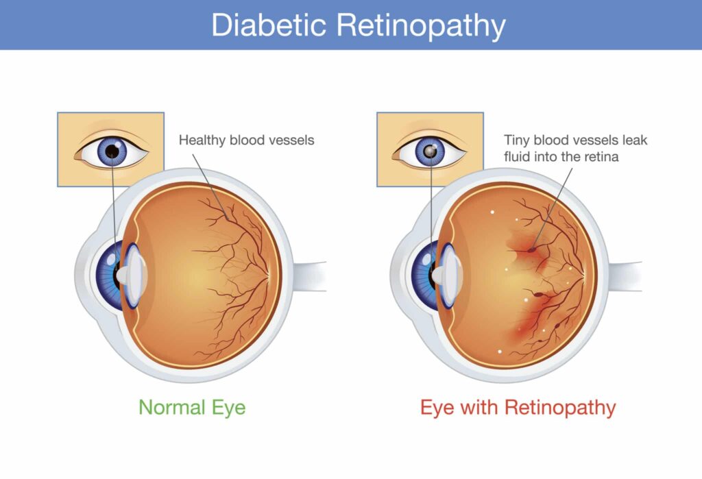 diabetes related eye problem