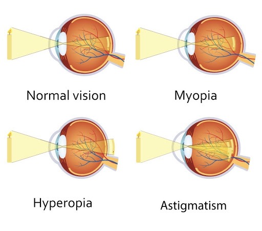 Causes of refractive errors