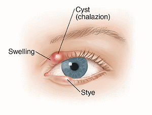 causes of Chalazion