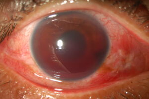 symptoms of hyphema