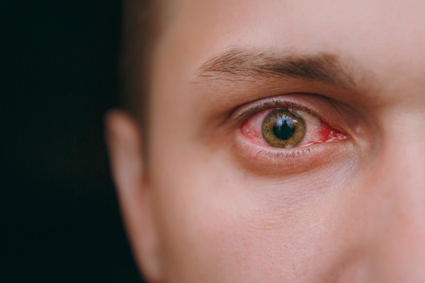 symptoms of eye infection