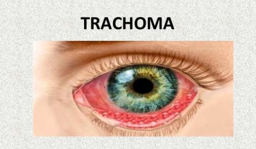 symptoms of trachoma
