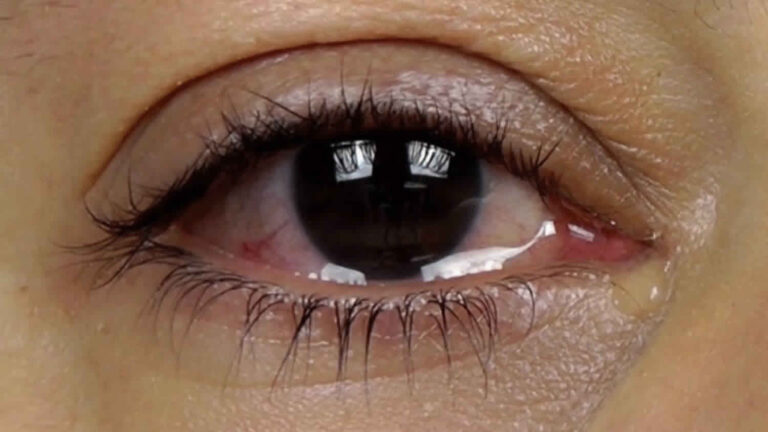 Watery Eyes: Causes and Treatment | Shekar Eye Hospital