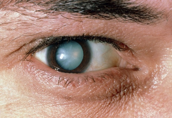 Types of cataract