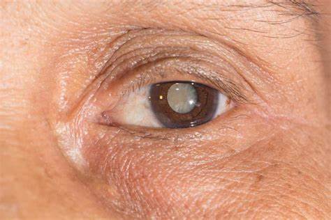 how to prevent cataracts