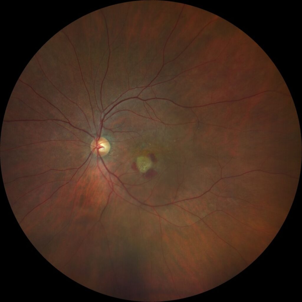 Age-Related Macular Degeneration