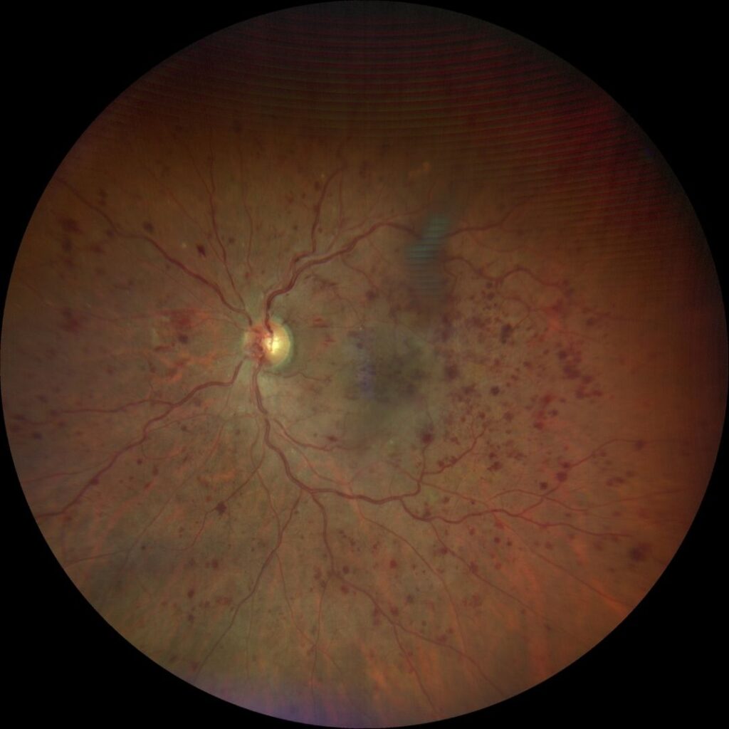 Central Retinal Vein Occlusion