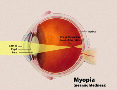 Understanding Myopia and Hypermetropia
