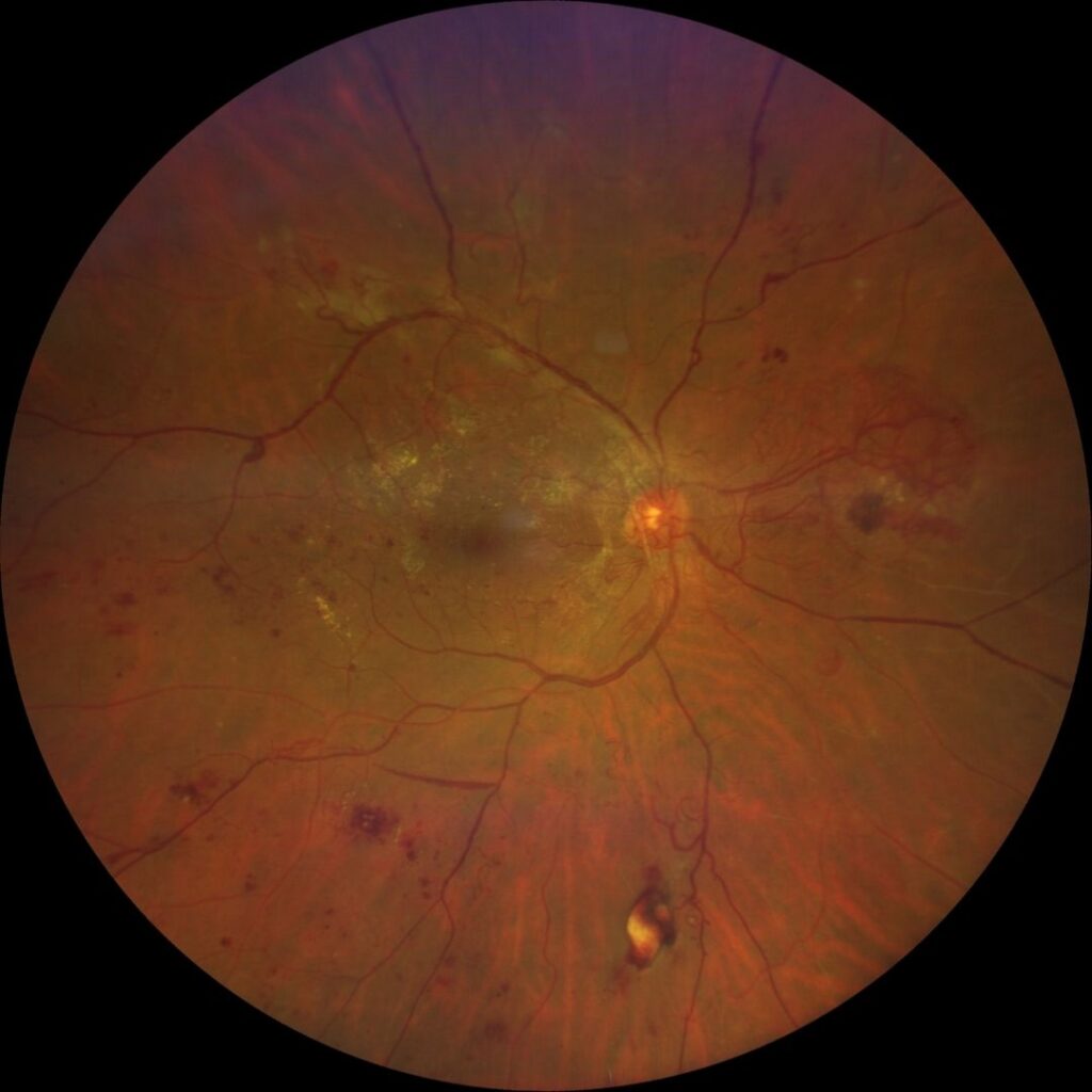 Proliferative Diabetic Retinopathy1