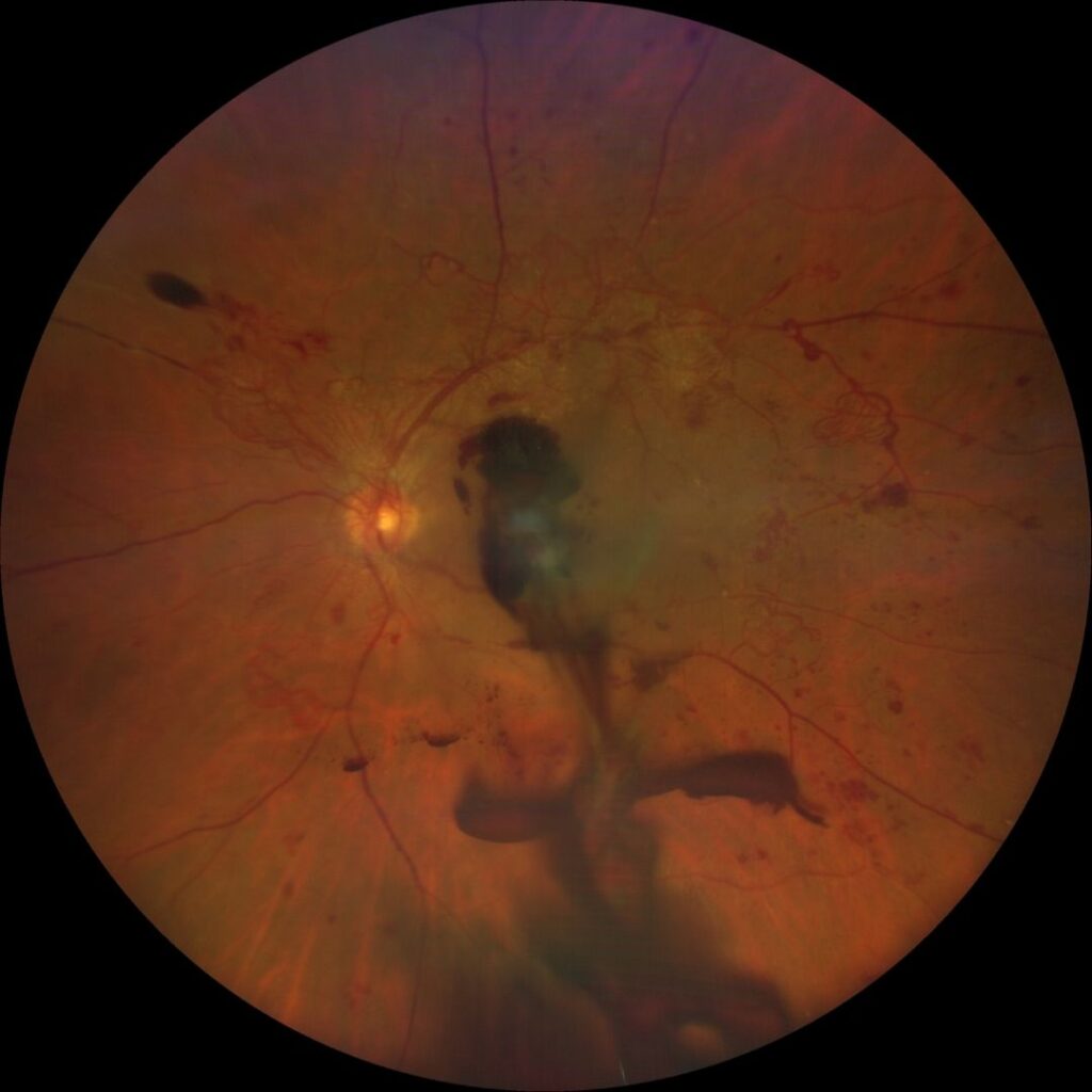 Proliferative Diabetic Retinopathy2