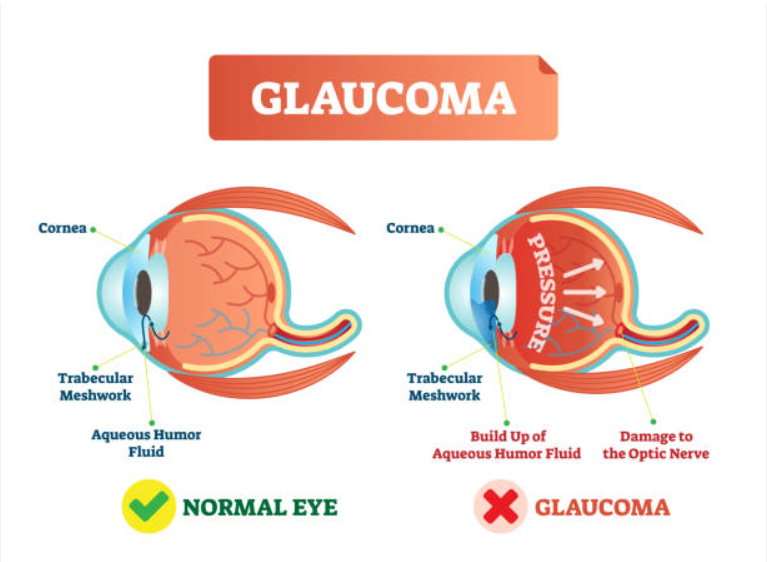 Glaucoma Eye Treatment