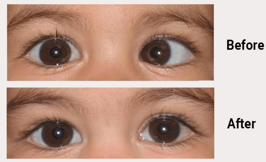 Squint Eye Surgery