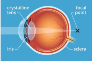 Understanding Presbyopia