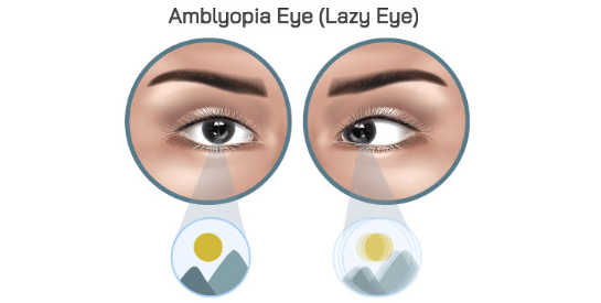 Amblyopia